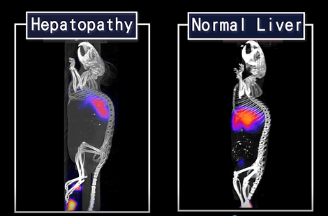 Therefore, by asialoglycoprotein receptor imaging technique, we can sensitively to see the imaging difference between normal liver and diseased liver